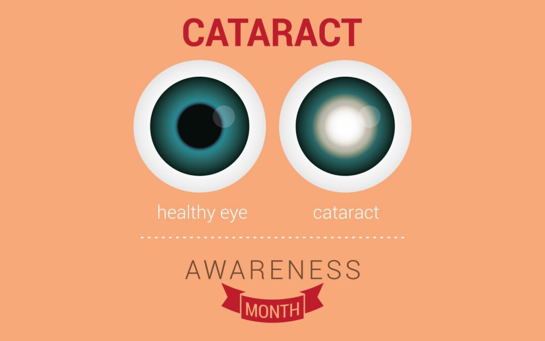 What You NEED To Know About Cataracts